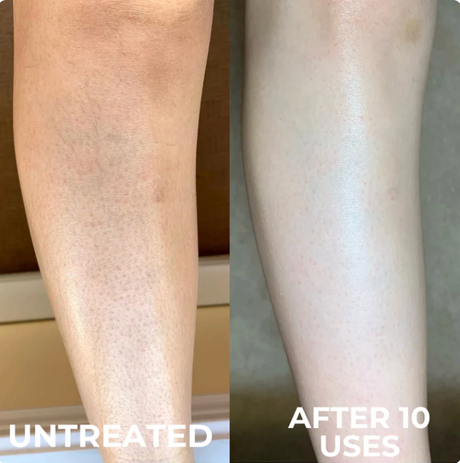 Savro Advanced Triple-Acid Complex for Keratosis Pilaris
