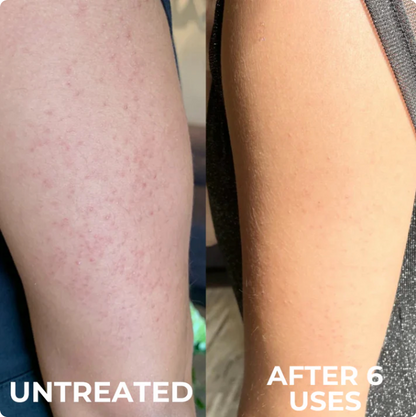 Savro Advanced Triple-Acid Complex for Keratosis Pilaris