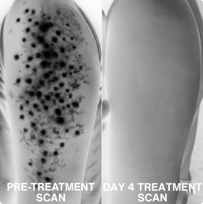 Savro Advanced Triple-Acid Complex for Keratosis Pilaris